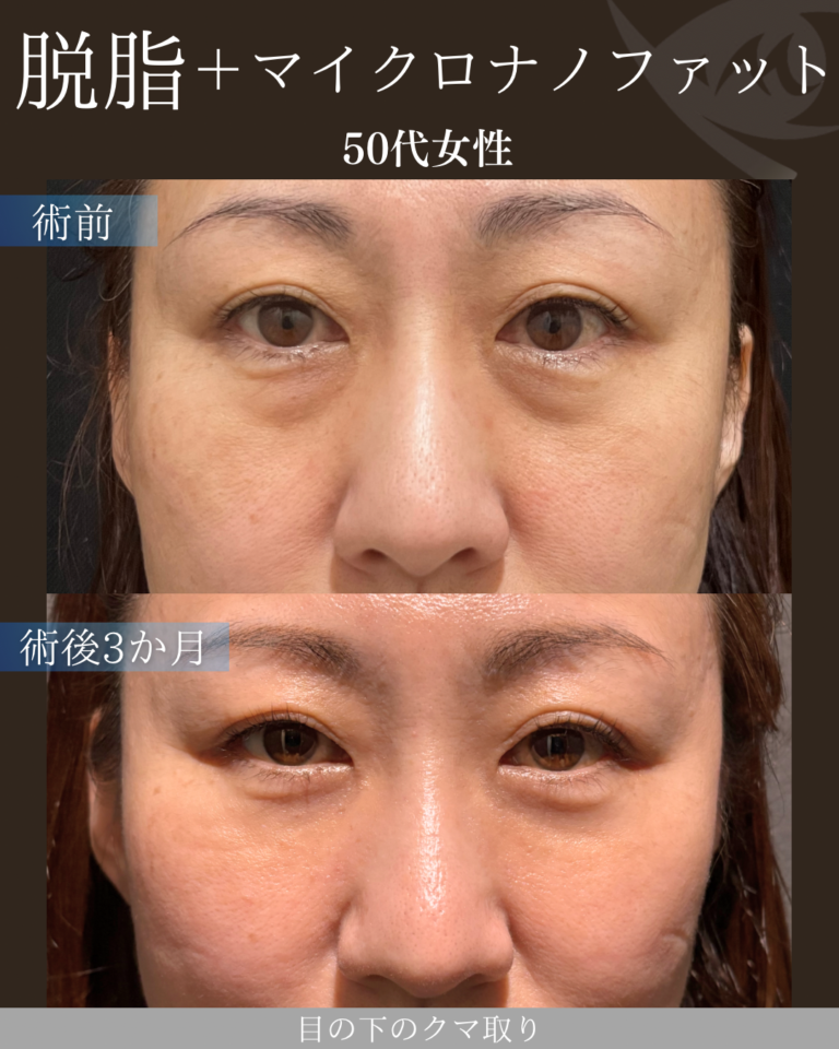 50代女性 経結膜脱脂術＋マイクロナノファット 術後3ヶ月
